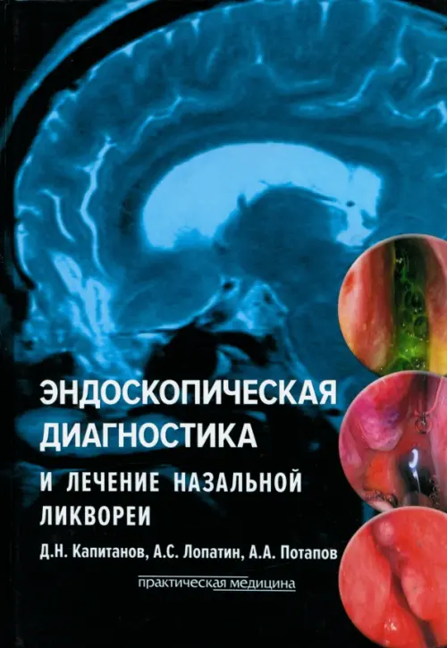 

Эндоскопическая диагностика и лечение назальной ликвореи, Синий