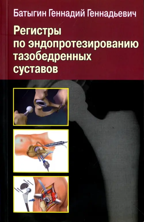 

Регистры по эндопротезированию тазобедренных суставов, Чёрный