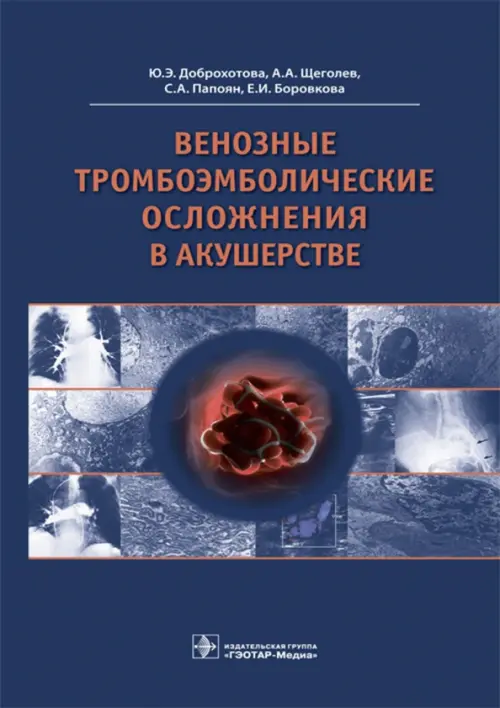 

Венозные тромбоэмболические осложнения в акушерстве, Синий