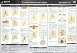 Плакат "Техника наложения швов" 84х59 см. (в тубусе)