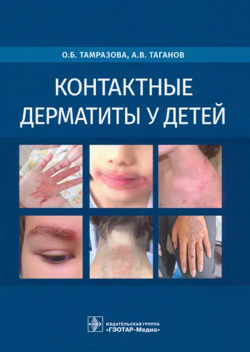 

Контактные дерматиты у детей, Синий